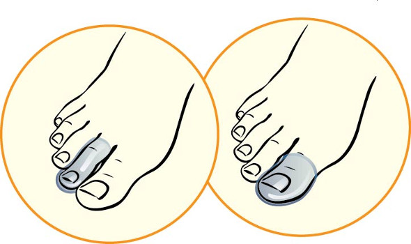 silikonovye-protektory-dlya-palcev-stopy-3